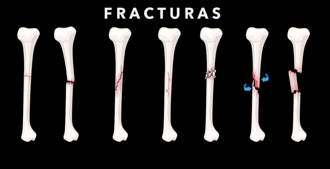 fracturas-en-los-huesos