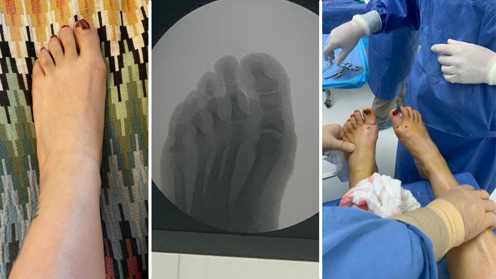 Hallux-Valgus-o-Juanete